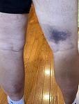 Click image for larger version. 

Name:	Bruise.jpg 
Views:	154 
Size:	88.1 KB 
ID:	15002